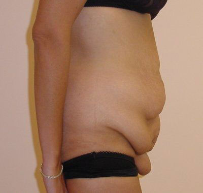 Tummy Tuck Before And After Photo