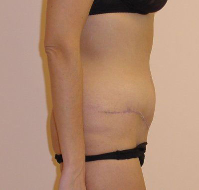 Tummy Tuck Before And After Photo