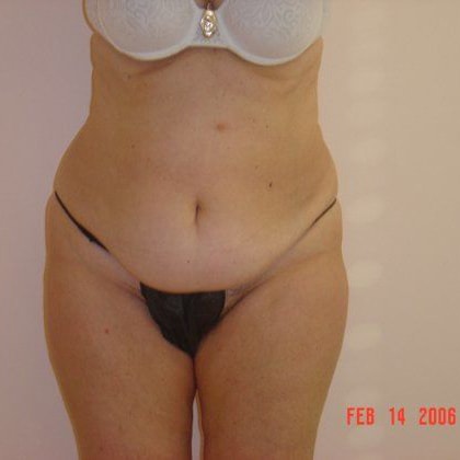 Tummy Tuck Before And After Photo