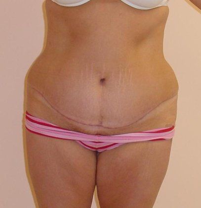 Abdominoplasty Before And After Patient 19