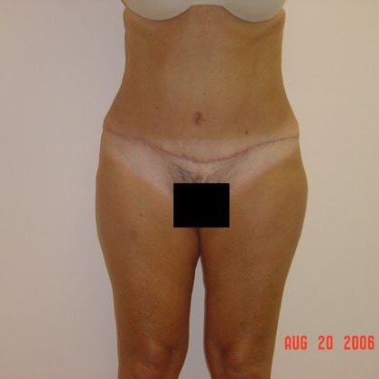 Abdominoplasty Before And After Patient 19