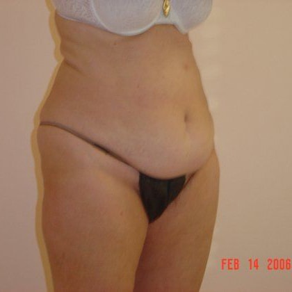 Tummy Tuck Before And After Photo