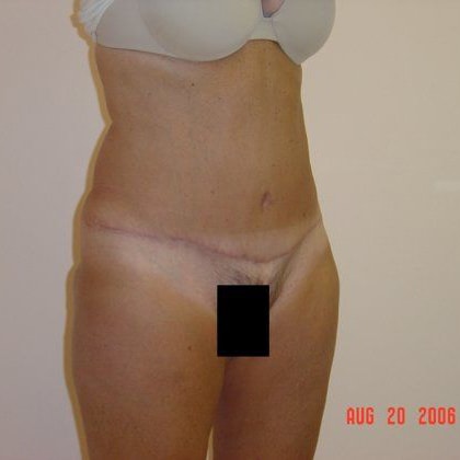 Tummy Tuck Before And After Photo