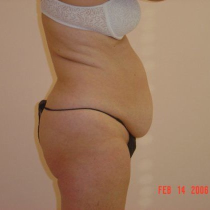 Tummy Tuck Before And After Photo