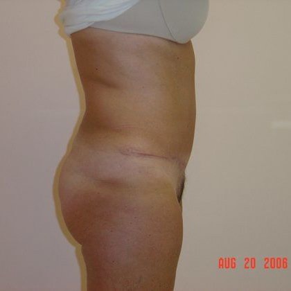 Tummy Tuck Before And After Photo