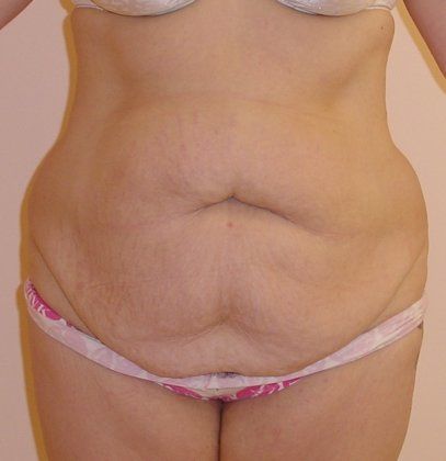 Tummy Tuck Before And After Photo