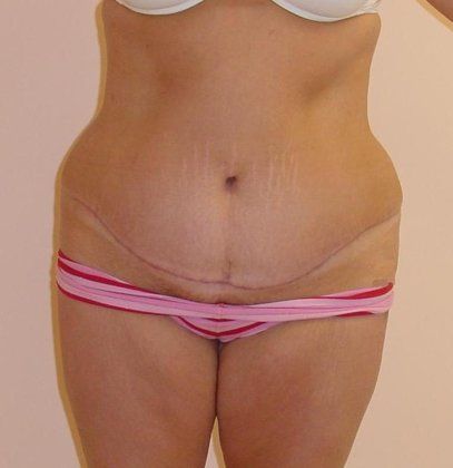 Tummy Tuck Before And After Photo