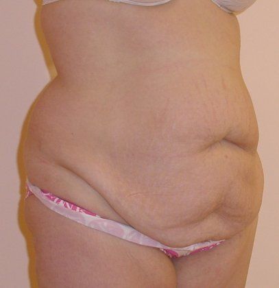 Tummy Tuck Before And After Photo