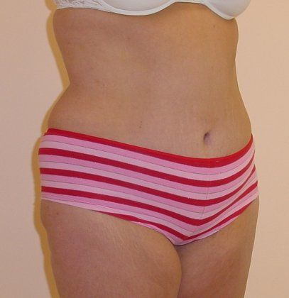 Tummy Tuck Before And After Photo