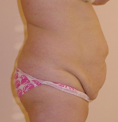 Tummy Tuck Before And After Photo