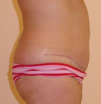 Tummy Tuck Before And After Photo