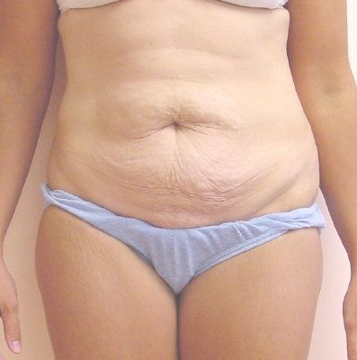 Tummy Tuck Before And After Photo