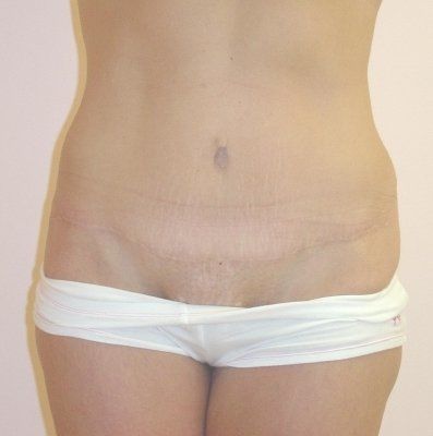 Tummy Tuck Before And After Photo