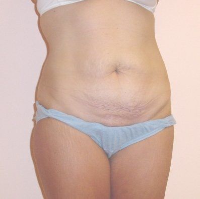 Tummy Tuck Before And After Photo