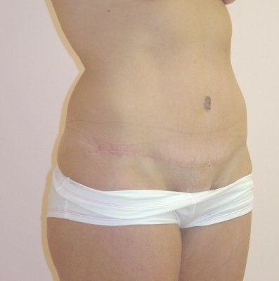 Tummy Tuck Before And After Photo