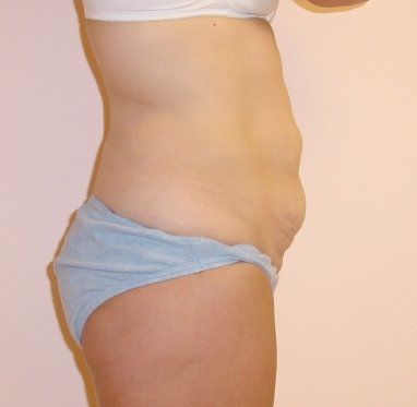 Tummy Tuck Before And After Photo