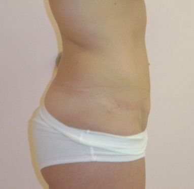 Tummy Tuck Before And After Photo