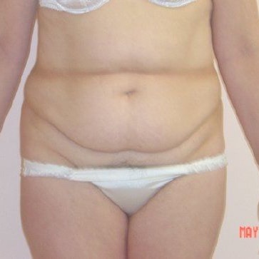 Tummy Tuck Before And After Photo