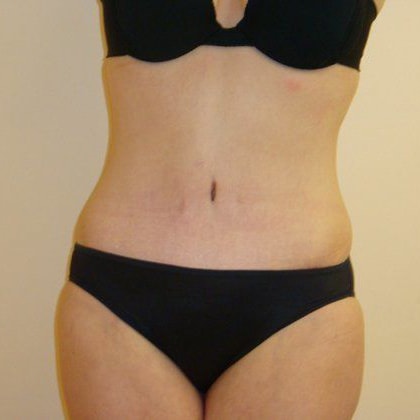 Abdominoplasty Before And After Patient 22