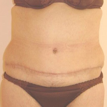 Tummy Tuck Before And After Photo