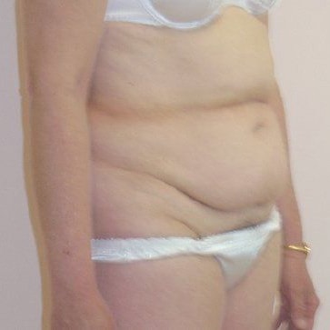 Tummy Tuck Before And After Photo