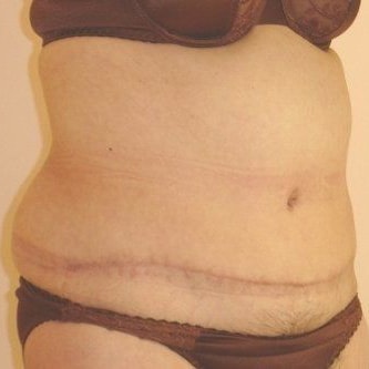 Tummy Tuck Before And After Photo