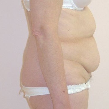 Tummy Tuck Before And After Photo