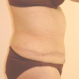 Tummy Tuck Before And After Photo