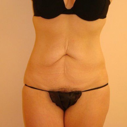 Tummy Tuck Before And After Photo