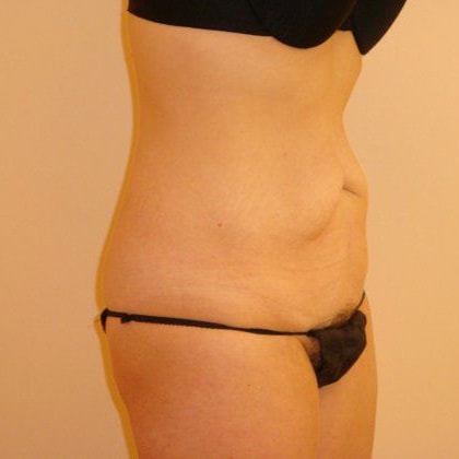 Tummy Tuck Before And After Photo