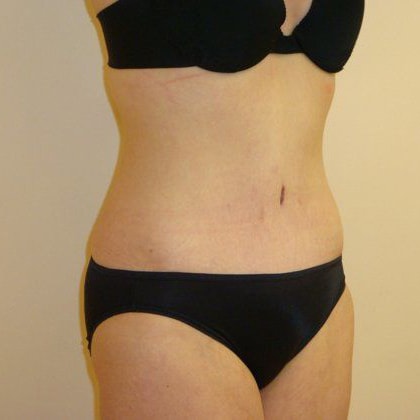 Tummy Tuck Before And After Photo