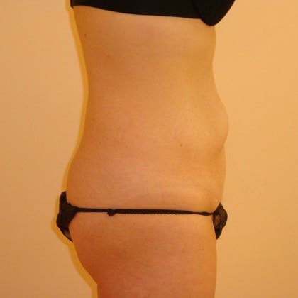 Tummy Tuck Before And After Photo