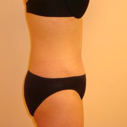 Tummy Tuck Before And After Photo