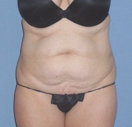 Tummy Tuck Before And After Photo