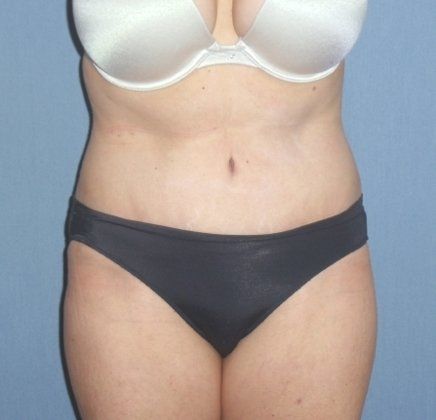 Tummy Tuck Before And After Photo