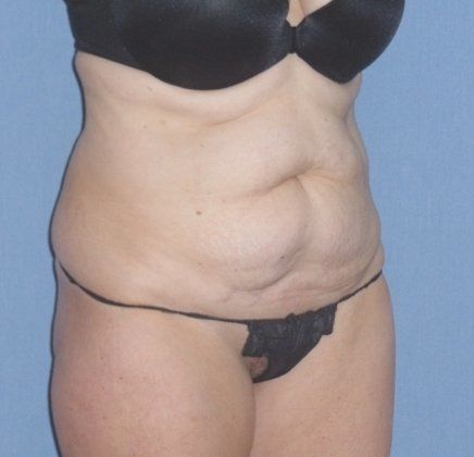 Tummy Tuck Before And After Photo