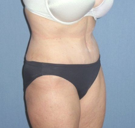 Tummy Tuck Before And After Photo