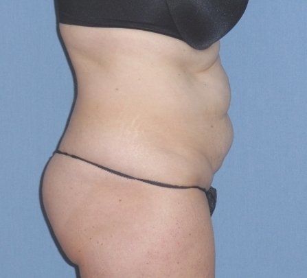 Tummy Tuck Before And After Photo