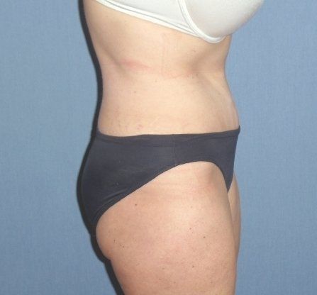 Tummy Tuck Before And After Photo