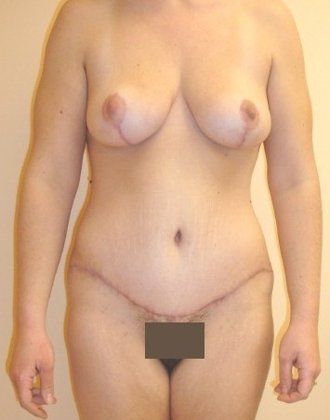 Abdominoplasty Before And After Patient 25