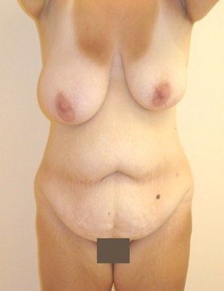 Tummy Tuck Before And After Photo