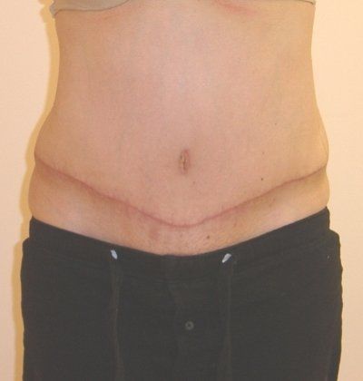 Abdominoplasty Before And After Patient 26