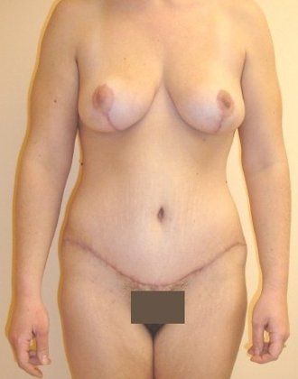 Tummy Tuck Before And After Photo