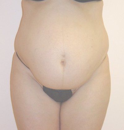 Tummy Tuck Before And After Photo