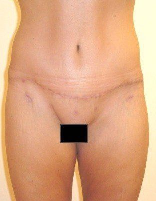 Tummy Tuck Before And After Patient 27