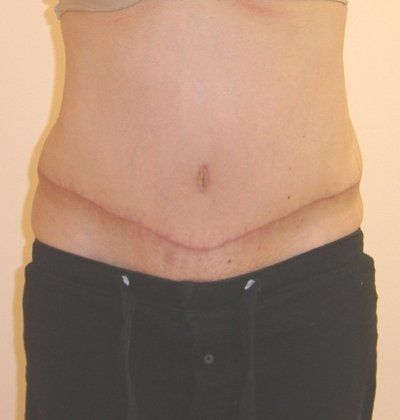 Tummy Tuck Before And After Patient 27