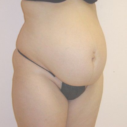 Tummy Tuck Before And After Photo