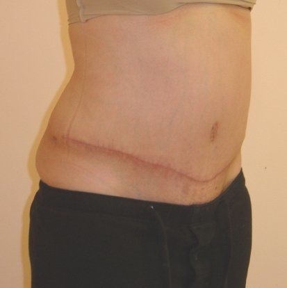 Tummy Tuck Before And After Photo