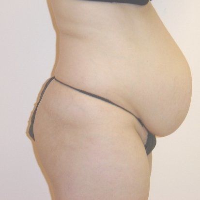 Tummy Tuck Before And After Photo