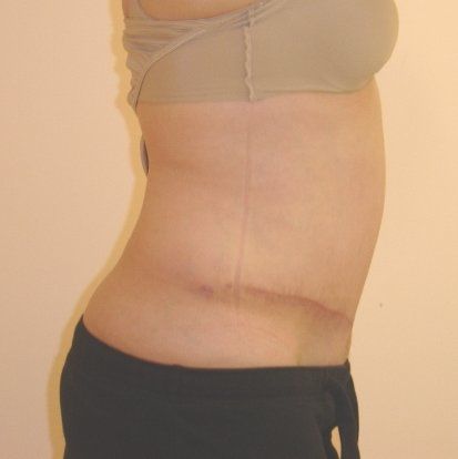 Tummy Tuck Before And After Photo